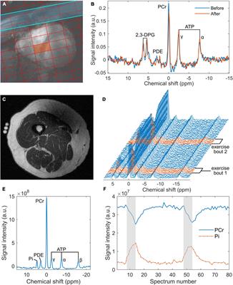 Evaluation of Acute Supplementation With the Ketone Ester (R)-3-Hydroxybutyl-(R)-3-Hydroxybutyrate (deltaG) in Healthy Volunteers by Cardiac and Skeletal Muscle 31P Magnetic Resonance Spectroscopy